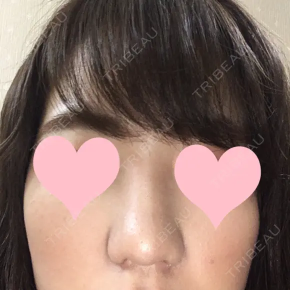 小鼻縮小（切開） JUN CLINIC DAY 9 メイン用