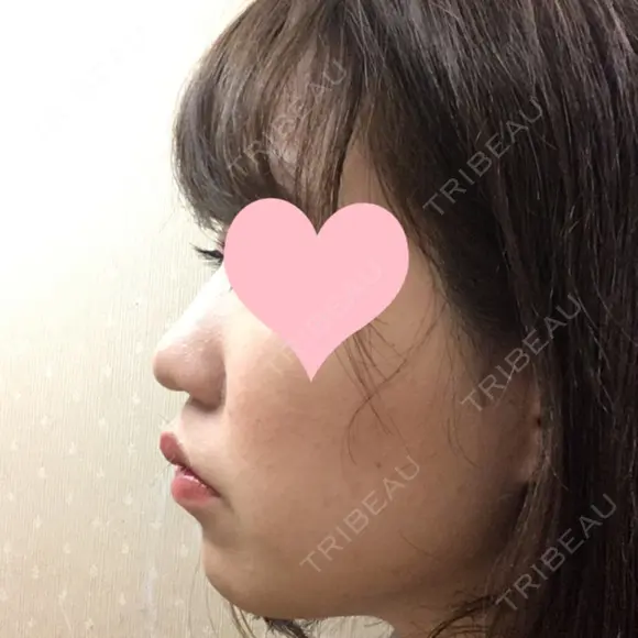 小鼻縮小（切開） JUN CLINIC DAY 9 メイン用