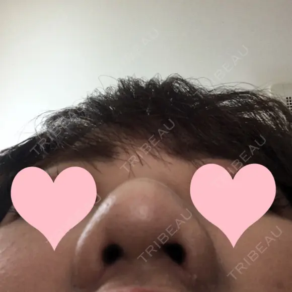 小鼻縮小（切開） JUN CLINIC DAY 9 メイン用
