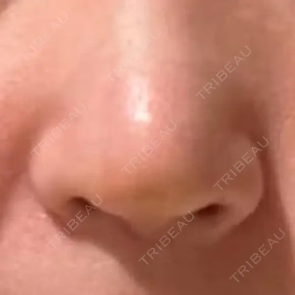 鼻尖形成（切開） / 軟骨移植 / 鼻孔縁下降 / 鼻柱下降・鼻唇角形成（猫手術） もとび美容外科クリニック 新宿院 DAY 6 メイン用