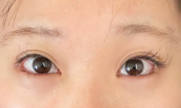 目尻切開 / タレ目形成・グラマラスライン（埋没） LOUIS CLINIC 二子玉川院【ルイクリニック】 DAY 2 メイン用