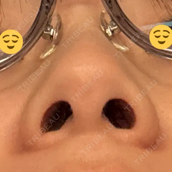 小鼻縮小（切開） 山本クリニック DAY 268 メイン用