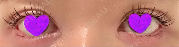 目尻切開 / タレ目形成・グラマラスライン（埋没） LOUIS CLINIC 二子玉川院【ルイクリニック】 AFTER メイン用