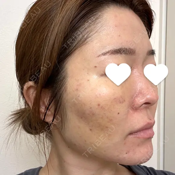 サブシジョン 藤・ナチュレ美容クリニック 銀座院 DAY 7 メイン用