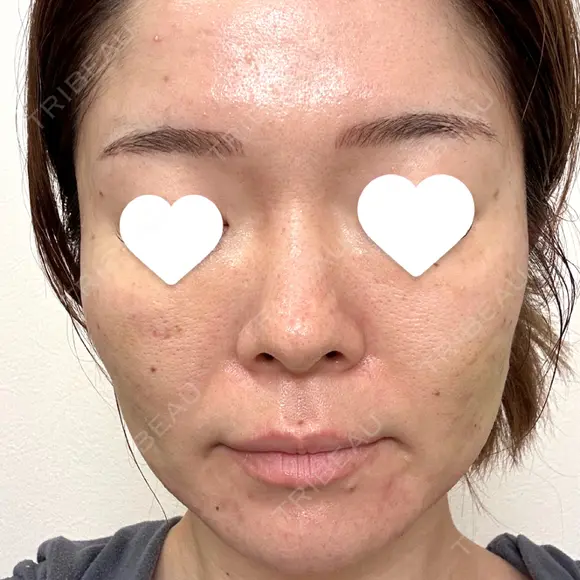 サブシジョン 藤・ナチュレ美容クリニック 銀座院 DAY 7 メイン用