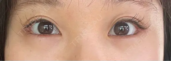 目尻切開 / タレ目形成・グラマラスライン（埋没） LOUIS CLINIC 二子玉川院【ルイクリニック】 DAY 4 メイン用