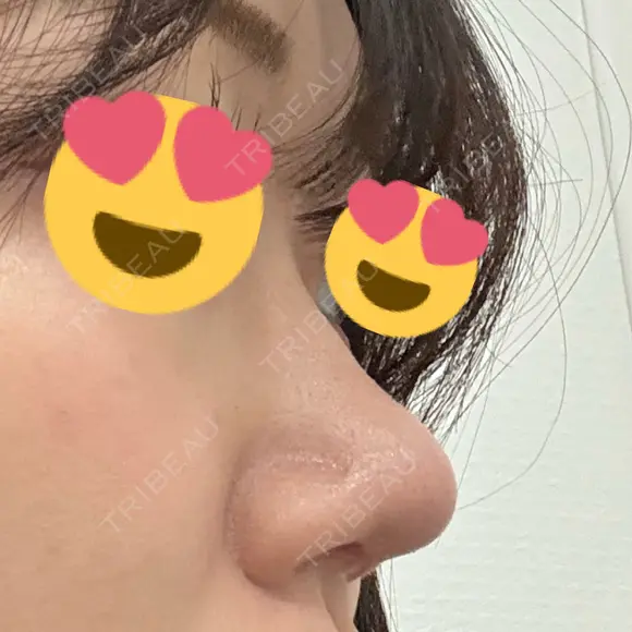 鼻尖形成（切開） / 軟骨移植 / 鼻尖縮小 / 鼻翼基部形成（貴族手術） / ヒアルロン酸注入（鼻翼基部） 東京シンデレラ美容外科 新宿院 DAY 43 メイン用