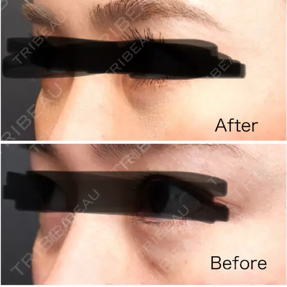 クマ治療 / 下まぶたの脂肪取り Tokyo Tensei Clinic 新宿院 DAY 7 メイン用