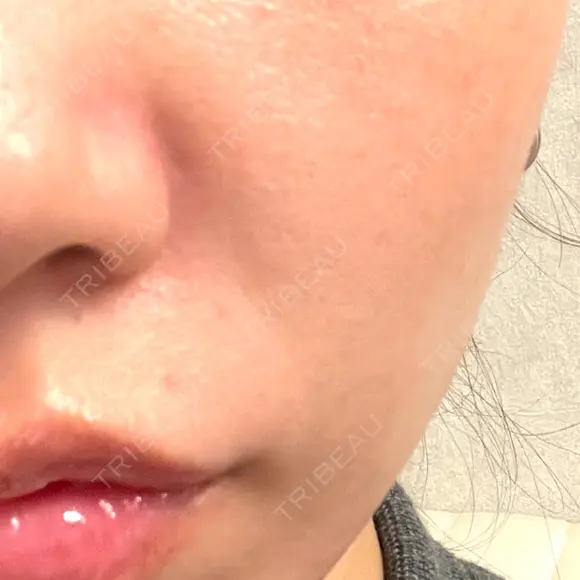 ボトックス（あご） / ボトックス（口角） / ボトックス（額） BiBiクリニック AFTER メイン用