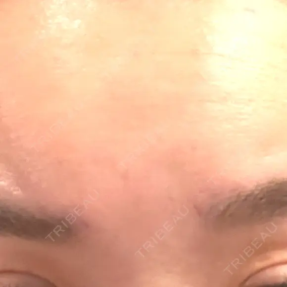 ボトックス（あご） / ボトックス（口角） / ボトックス（額） BiBiクリニック DAY 0 メイン用