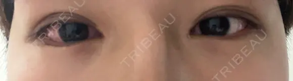 クマ治療 / 下まぶたの脂肪取り ROOTS Clinic DAY 0 メイン用