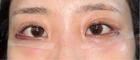 下まぶたの脂肪取り / タレ目形成・グラマラスライン（切開） / 目尻靭帯移動 池袋麗歯科・美容皮膚科 DAY 1 メイン用