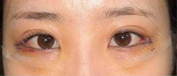 下まぶたの脂肪取り / タレ目形成・グラマラスライン（切開） / 目尻靭帯移動 池袋麗歯科・美容皮膚科 DAY 3 メイン用