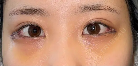 下まぶたの脂肪取り / タレ目形成・グラマラスライン（切開） / 目尻靭帯移動 池袋麗歯科・美容皮膚科 DAY 5 メイン用