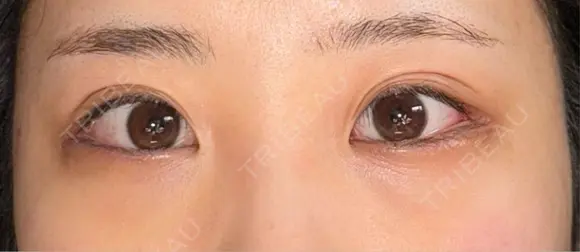 下まぶたの脂肪取り / タレ目形成・グラマラスライン（切開） / 目尻靭帯移動 池袋麗歯科・美容皮膚科 AFTER メイン用