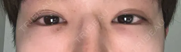 クマ治療 / 下まぶたの脂肪取り ROOTS Clinic DAY 1 メイン用