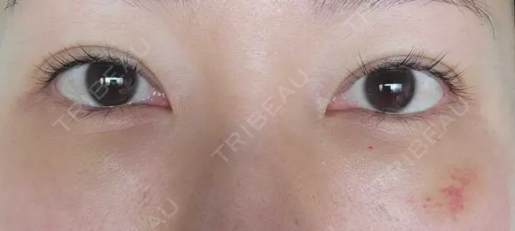 クマ治療 / 下まぶたたるみ取り 湘南美容クリニック 千葉センシティ院 DAY 15 メイン用
