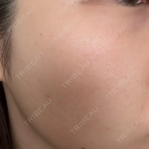 イオン導入 / 毛穴洗浄（ハイドラフェイシャルなど） / 光治療（フォトフェイシャルなど） / その他（鼻） ルラ美容クリニック 札幌本院 DAY 0 メイン用