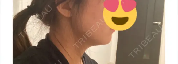 ハイフ（顔） 博多もへじのクリニック AFTER メイン用