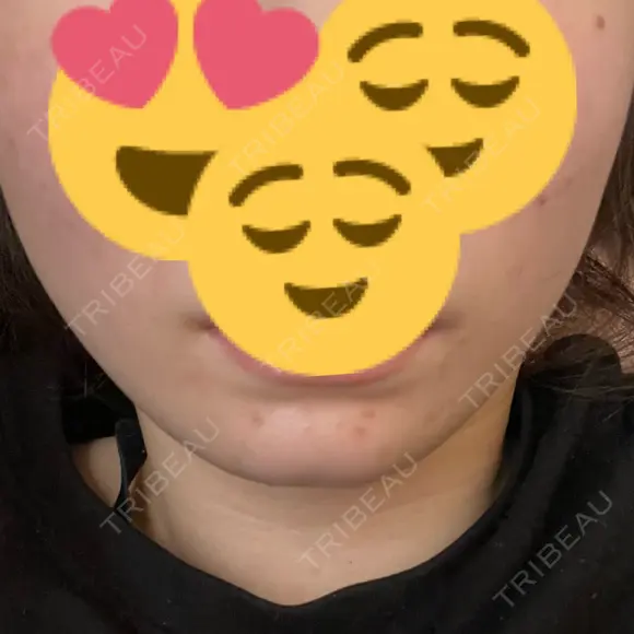 ボトックス（あご） ルラ美容クリニック 新宿院 DAY 2 メイン用