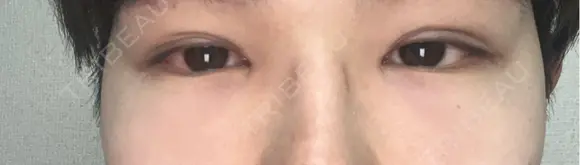 クマ治療 / 下まぶたの脂肪取り ROOTS Clinic DAY 2 メイン用