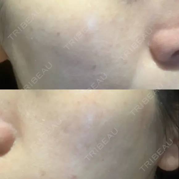 光治療（フォトフェイシャルなど） 小木曽クリニック DAY 43 メイン用