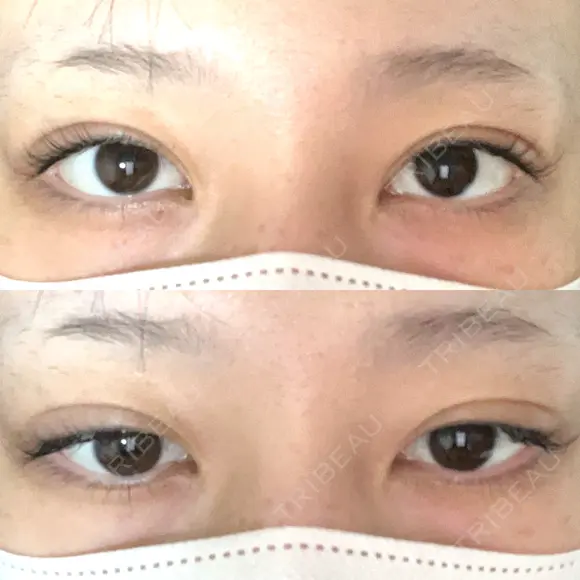二重埋没 BELINDA CLINIC（ベリンダクリニック）新宿院 AFTER メイン用