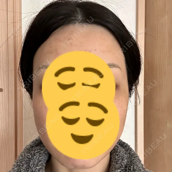 ボトックス（エラ・小顔） TCB東京中央美容外科 梅田茶屋町院 DAY 1 メイン用