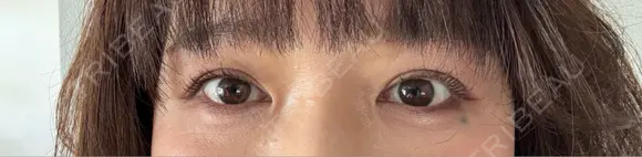 眉下切開 / ヒアルロン酸注入（鼻翼基部） WOM CLINIC GINZA （ワム クリニック ギンザ） DAY 36 メイン用