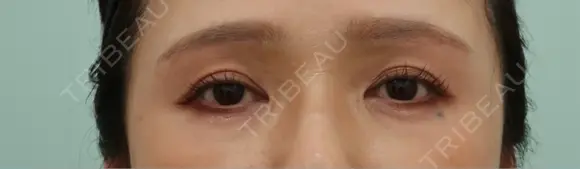 眉下切開 / ヒアルロン酸注入（鼻翼基部） WOM CLINIC GINZA （ワム クリニック ギンザ） DAY 36 メイン用