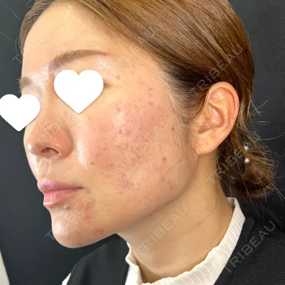 サブシジョン 藤・ナチュレ美容クリニック 銀座院 DAY 12 メイン用