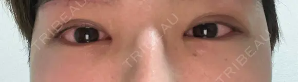 クマ治療 / 下まぶたの脂肪取り ROOTS Clinic DAY 3 メイン用