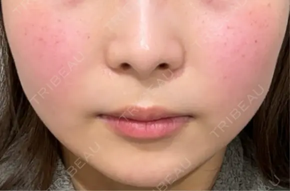 目尻切開 / タレ目形成・グラマラスライン（埋没） / ボトックス（エラ・小顔） LOUIS CLINIC 二子玉川院【ルイクリニック】 DAY 3 メイン用