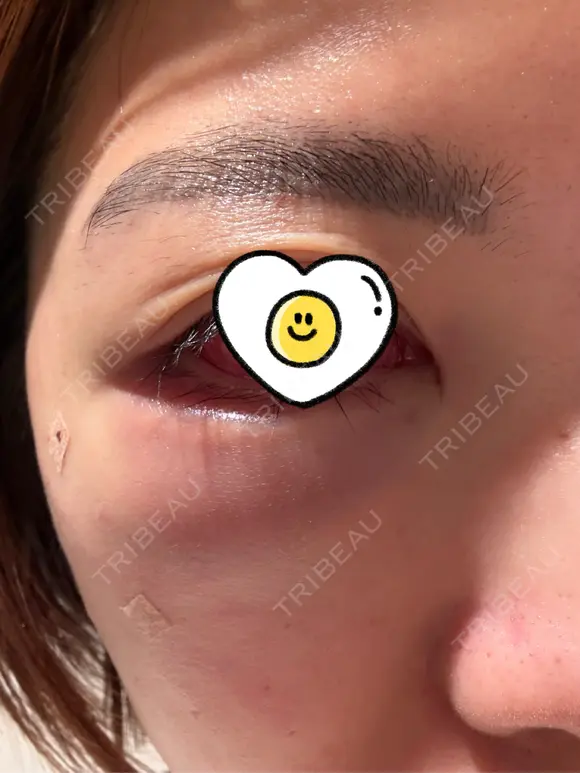 クマ治療 / 豊胸（脂肪注入） / 脂肪注入（目の下） R Beauty CLINIC 銀座院 DAY 0 メイン用