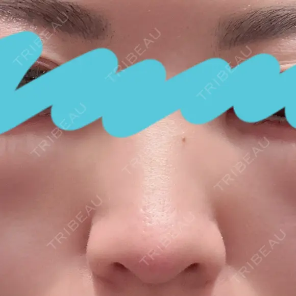 クマ治療 / 豊胸（脂肪注入） / 脂肪注入（目の下） R Beauty CLINIC 銀座院 AFTER メイン用