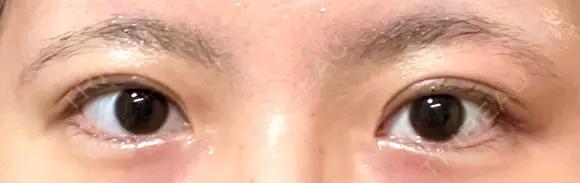 二重切開 EMMA CLINIC（エマクリニック） DAY 30 メイン用