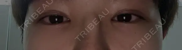 クマ治療 / 下まぶたの脂肪取り ROOTS Clinic DAY 4 メイン用