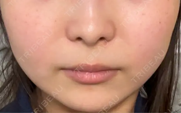 目尻切開 / タレ目形成・グラマラスライン（埋没） / ボトックス（エラ・小顔） LOUIS CLINIC 二子玉川院【ルイクリニック】 DAY 4 メイン用