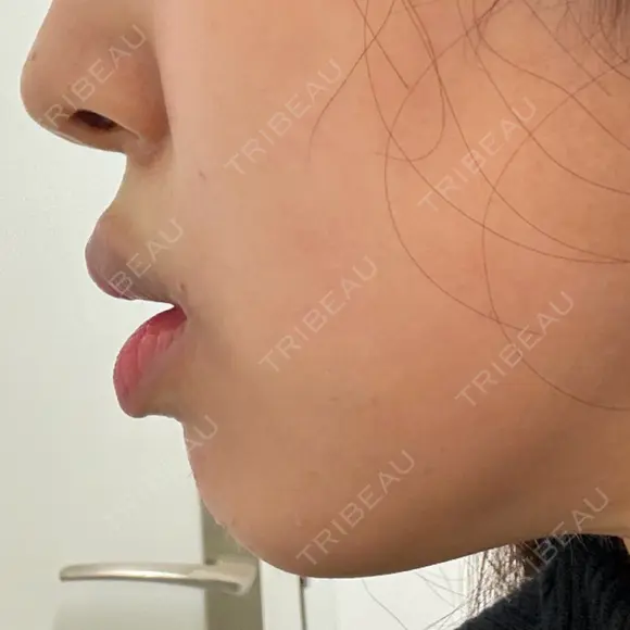 ボトックス（あご） / ボトックス（ふくらはぎ） / ボトックス（太もも） DMTC CLINIC 日本橋院 AFTER メイン用