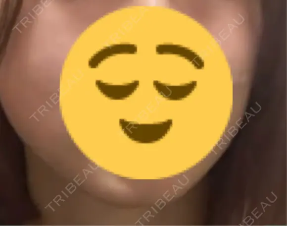 ボトックス（あご） ルラ美容クリニック 新宿院 DAY 5 メイン用