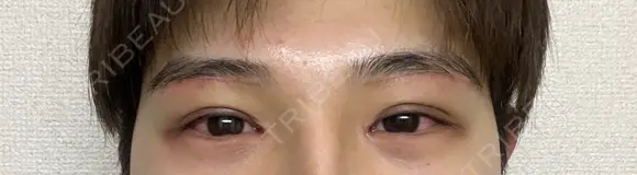 クマ治療 / 下まぶたの脂肪取り ROOTS Clinic AFTER メイン用