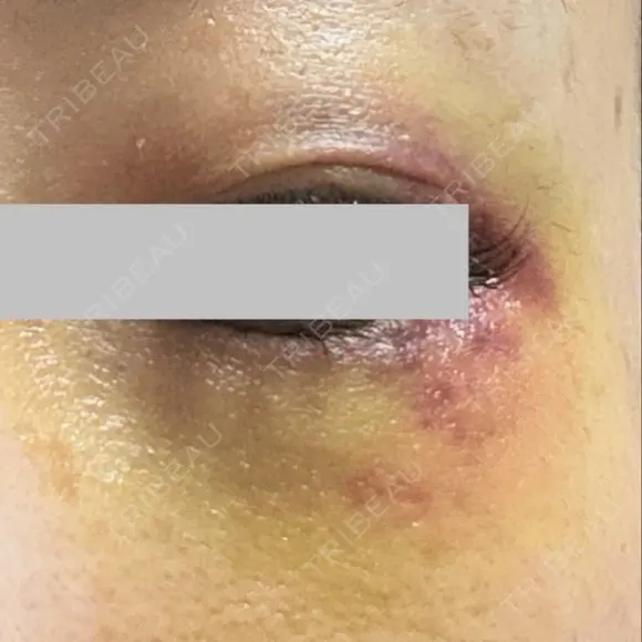 クマ治療 / ボトックス（眉間） / ボトックス（目尻） / ボトックス（額） TCB東京中央美容外科 船橋院 DAY 5 メイン用