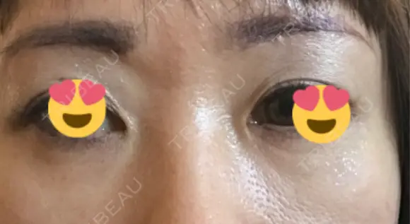 眉下切開 銀座リシェスクリニック DAY 62 メイン用