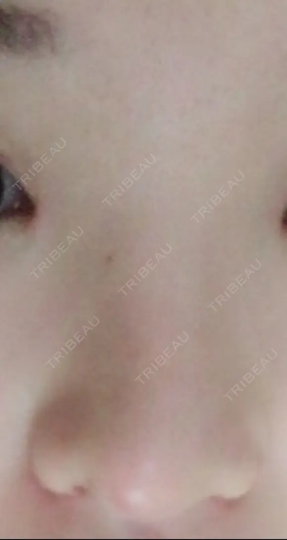 鼻尖形成（切開） / 鼻中隔延長（切開） / 小鼻縮小（切開） / 軟骨移植 / 骨切幅寄せ / 鼻尖縮小 HANABI整形外科 DAY 51 メイン用