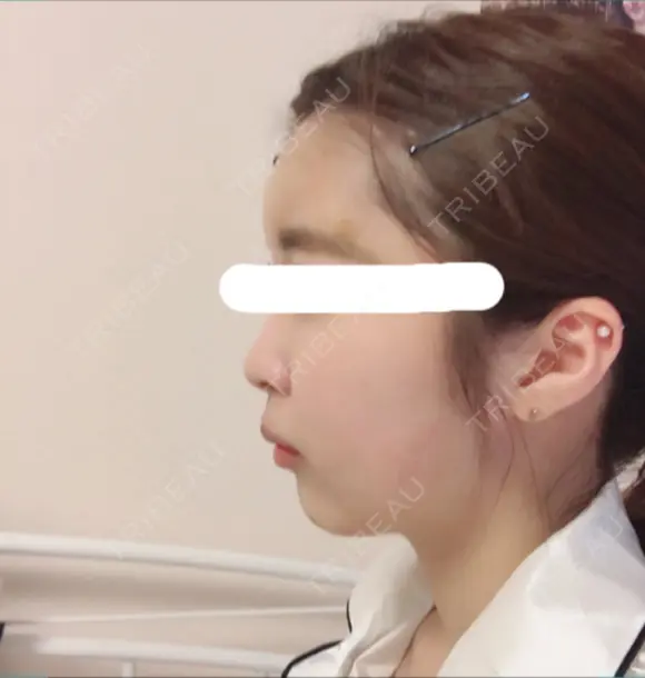 脂肪注入（輪郭） / 再生医療 / PRP皮膚再生療法 チョンダムオラクル皮膚科整形外科医院 DAY 7 メイン用