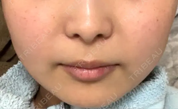 目尻切開 / タレ目形成・グラマラスライン（埋没） / ボトックス（エラ・小顔） LOUIS CLINIC 二子玉川院【ルイクリニック】 DAY 6 メイン用