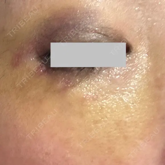 クマ治療 / ボトックス（眉間） / ボトックス（目尻） / ボトックス（額） TCB東京中央美容外科 船橋院 DAY 6 メイン用