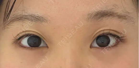目尻切開 / タレ目形成・グラマラスライン（埋没） LOUIS CLINIC 二子玉川院【ルイクリニック】 AFTER メイン用