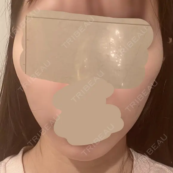 糸リフト / 肌ヒアルロン酸注入（たるみ・シワ改善） 上野美容外科・美容皮膚科 DAY 2 メイン用