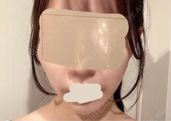 糸リフト / 肌ヒアルロン酸注入（たるみ・シワ改善） 上野美容外科・美容皮膚科 AFTER メイン用